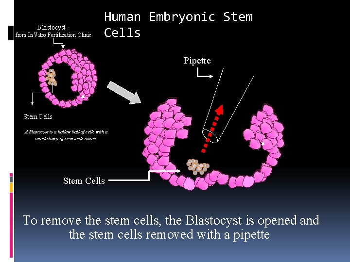 Blastocyst from In Vitro Fertilization Clinic Human Embryonic Stem Cells Pipette Stem Cells A Blastocyst from In Vitro Fertilization Clinic Human Embryonic Stem Cells Pipette Stem Cells A