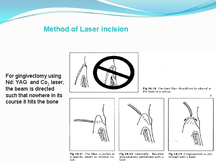 Method of Laser incision For gingivectomy using Nd: YAG and Co 2 laser, the Method of Laser incision For gingivectomy using Nd: YAG and Co 2 laser, the