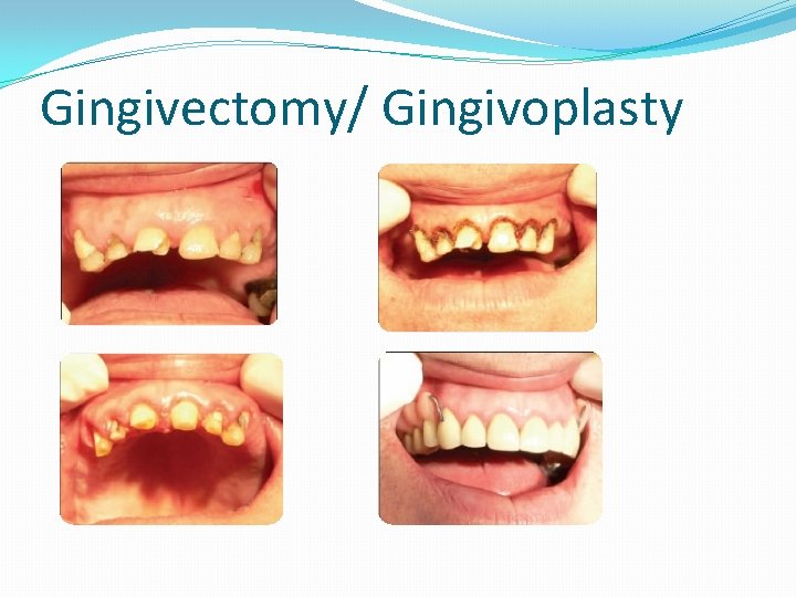 Gingivectomy/ Gingivoplasty Gingivectomy/ Gingivoplasty