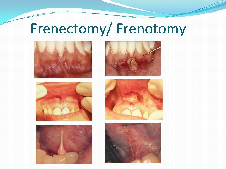 Frenectomy/ Frenotomy Frenectomy/ Frenotomy