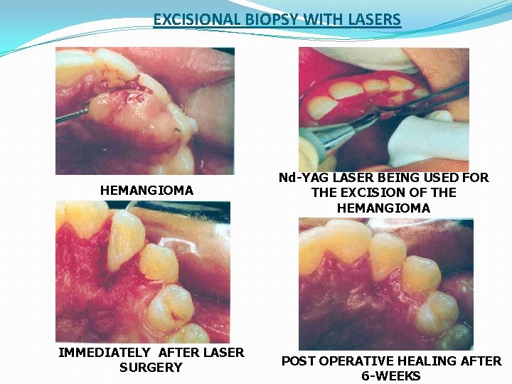EXCISIONAL BIOPSY WITH LASERS HEMANGIOMA IMMEDIATELY AFTER LASER SURGERY Nd-YAG LASER BEING USED FOR EXCISIONAL BIOPSY WITH LASERS HEMANGIOMA IMMEDIATELY AFTER LASER SURGERY Nd-YAG LASER BEING USED FOR