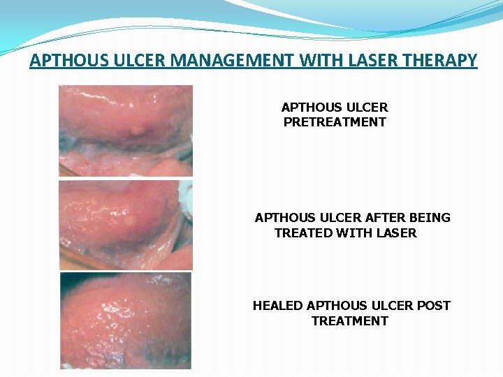 APTHOUS ULCER MANAGEMENT WITH LASER THERAPY APTHOUS ULCER PRETREATMENT APTHOUS ULCER AFTER BEING TREATED APTHOUS ULCER MANAGEMENT WITH LASER THERAPY APTHOUS ULCER PRETREATMENT APTHOUS ULCER AFTER BEING TREATED