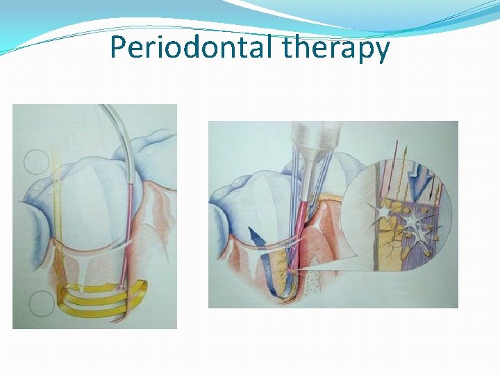 Periodontal therapy Periodontal therapy