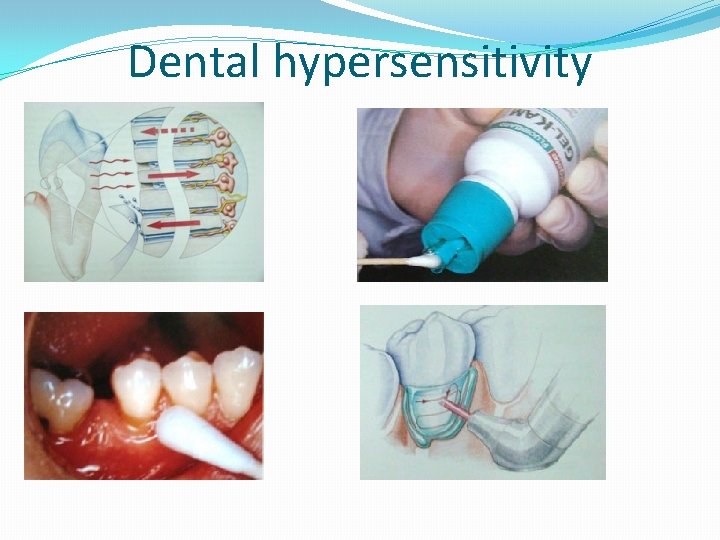 Dental hypersensitivity Dental hypersensitivity