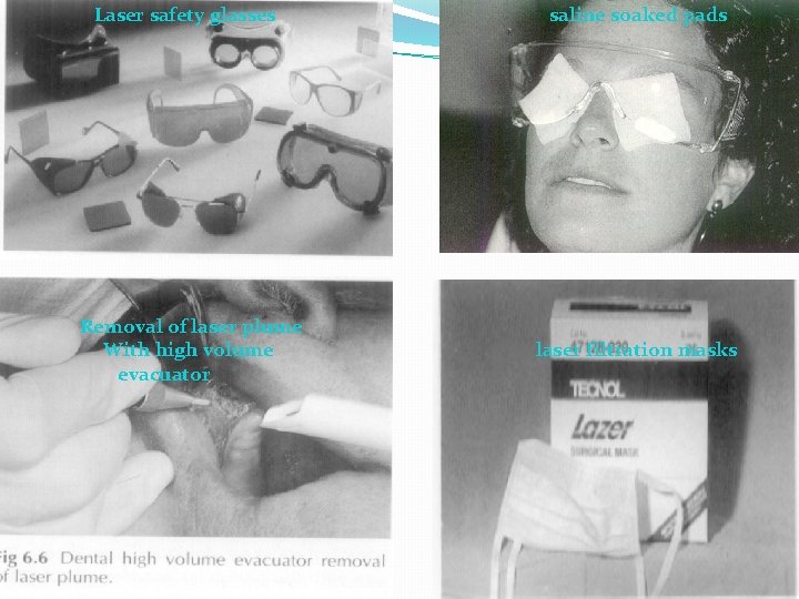 Laser safety glasses Removal of laser plume With high volume evacuator saline soaked pads Laser safety glasses Removal of laser plume With high volume evacuator saline soaked pads