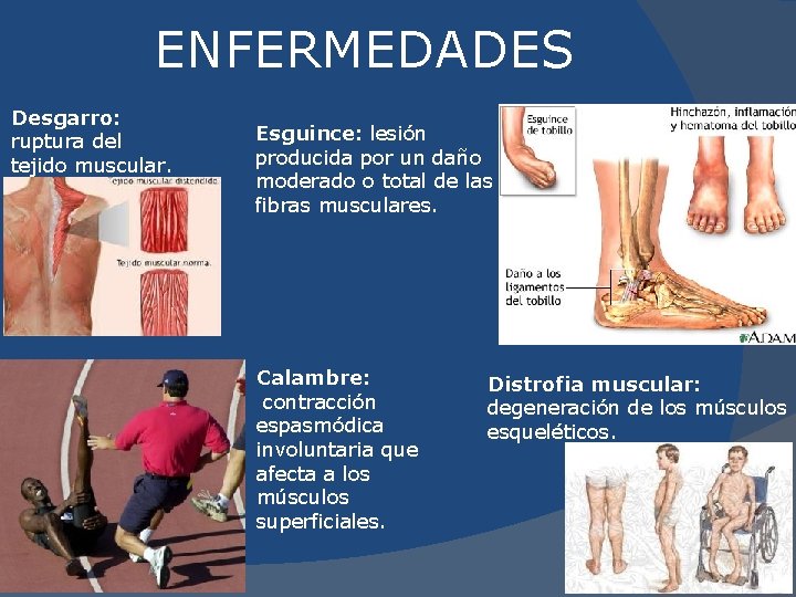 ENFERMEDADES Desgarro: ruptura del tejido muscular. Esguince: lesión producida por un daño moderado o