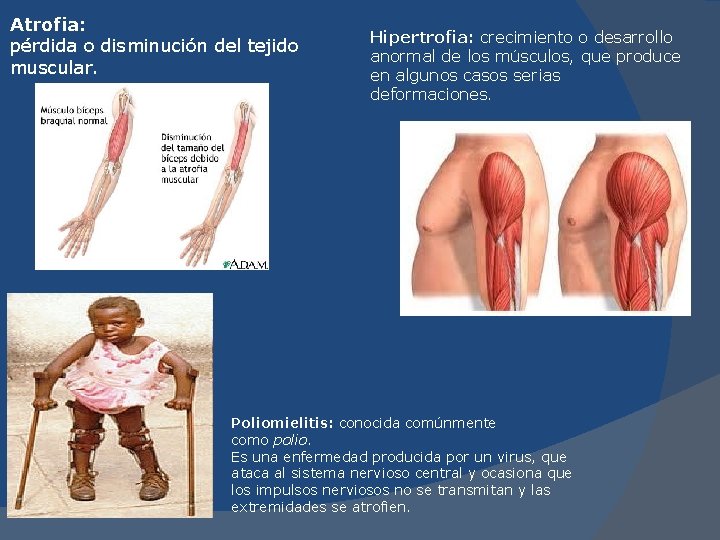 Atrofia: pérdida o disminución del tejido muscular. Hipertrofia: crecimiento o desarrollo anormal de los