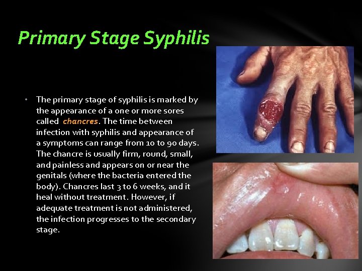 Primary Stage Syphilis • The primary stage of syphilis is marked by the appearance