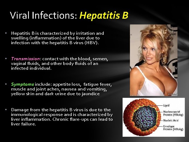 Viral Infections: Hepatitis B • Hepatitis B is characterized by irritation and swelling (inflammation)