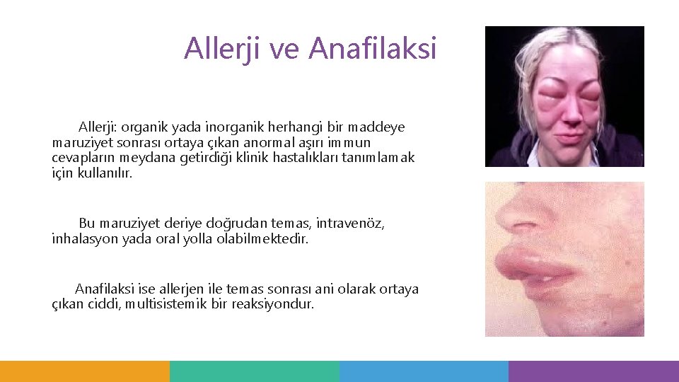 Allerji ve Anafilaksi Allerji: organik yada inorganik herhangi bir maddeye maruziyet sonrası ortaya çıkan Allerji ve Anafilaksi Allerji: organik yada inorganik herhangi bir maddeye maruziyet sonrası ortaya çıkan