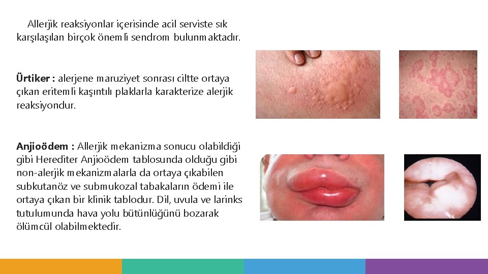 Allerjik reaksiyonlar içerisinde acil serviste sık karşılan birçok önemli sendrom bulunmaktadır. Ürtiker : alerjene Allerjik reaksiyonlar içerisinde acil serviste sık karşılan birçok önemli sendrom bulunmaktadır. Ürtiker : alerjene