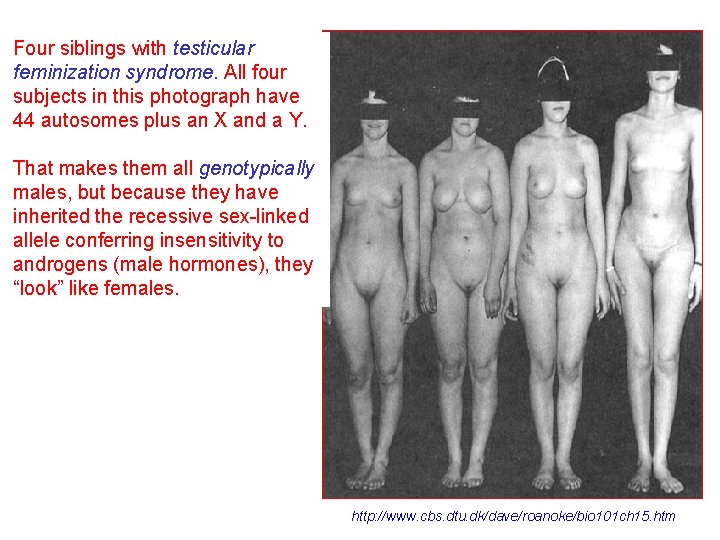 Four siblings with testicular feminization syndrome. All four subjects in this photograph have 44