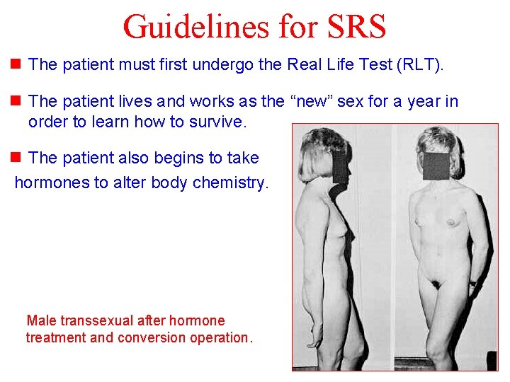 Guidelines for SRS n The patient must first undergo the Real Life Test (RLT).