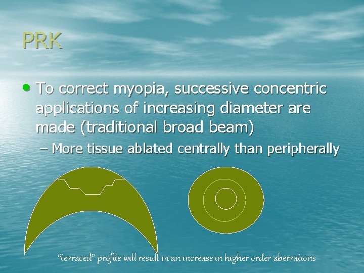 PRK • To correct myopia, successive concentric applications of increasing diameter are made (traditional