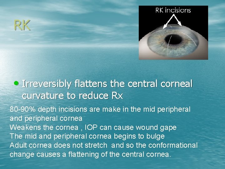 RK • Irreversibly flattens the central corneal curvature to reduce Rx 80 -90% depth