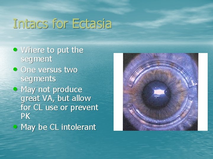 Intacs for Ectasia • Where to put the • • • segment One versus