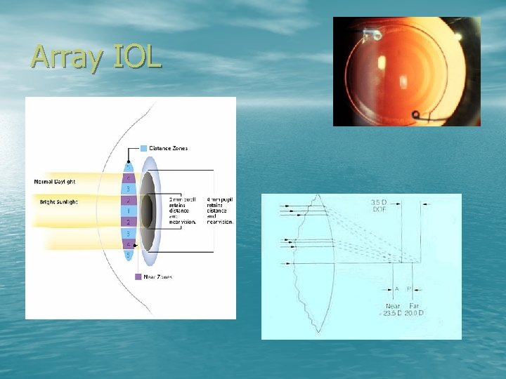 Array IOL 