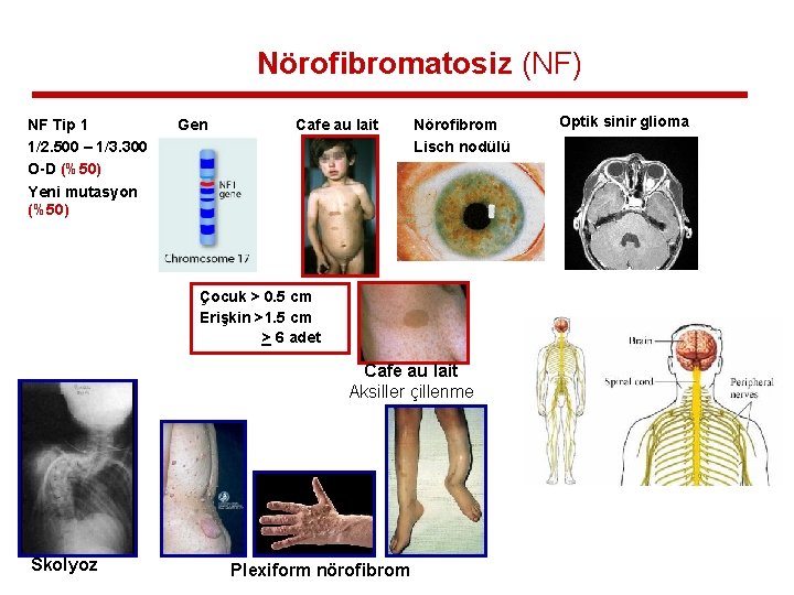 Nörofibromatosiz (NF) NF Tip 1 1/2. 500 – 1/3. 300 O-D (%50) Yeni mutasyon