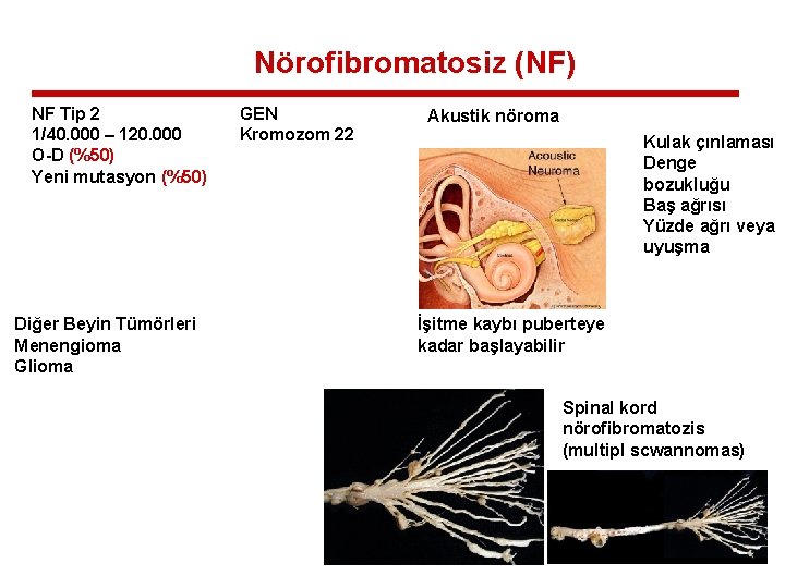 Nörofibromatosiz (NF) NF Tip 2 1/40. 000 – 120. 000 O-D (%50) Yeni mutasyon