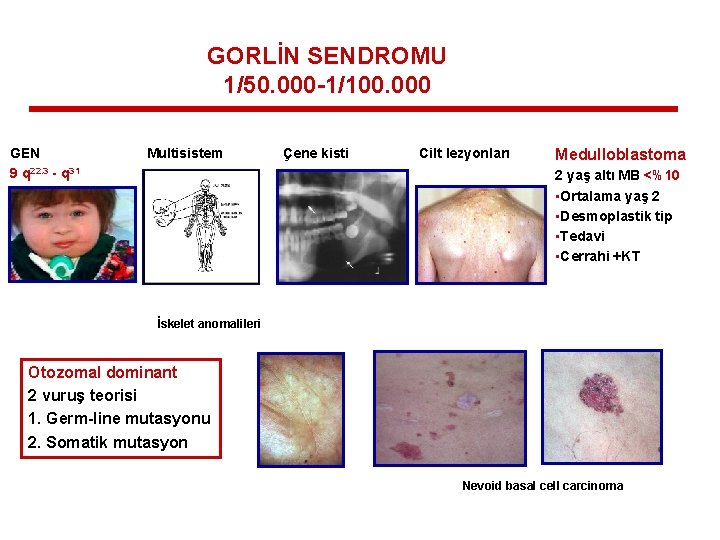 GORLİN SENDROMU 1/50. 000 -1/100. 000 GEN 9 q 22. 3 - q 31