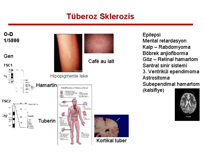Tüberoz Sklerozis O-D 1/5800 Gen Café au lait TSC 1 Hipopigmente leke Hamartin TSC