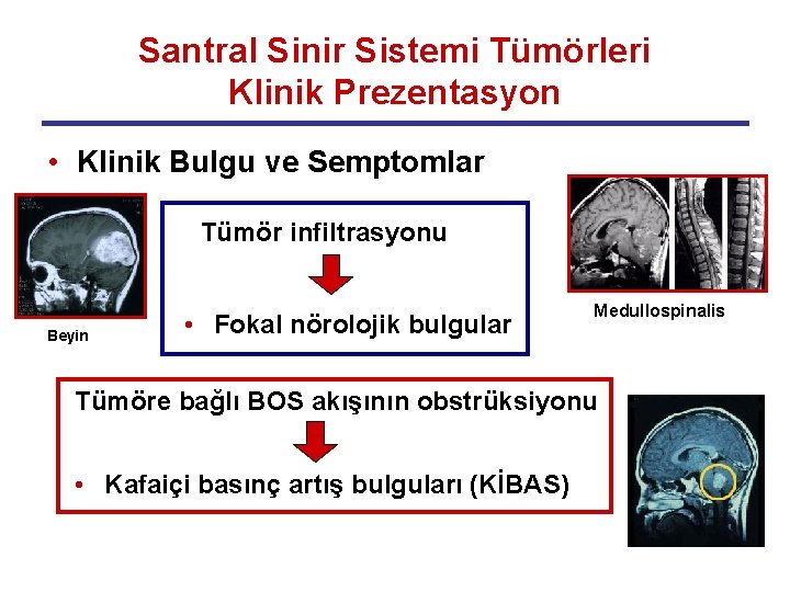 Santral Sinir Sistemi Tümörleri Klinik Prezentasyon • Klinik Bulgu ve Semptomlar Tümör infiltrasyonu Beyin