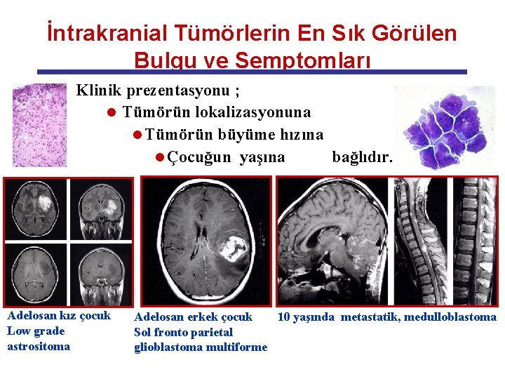 İntrakranial Tümörlerin En Sık Görülen Bulgu ve Semptomları Klinik prezentasyonu ; l Tümörün lokalizasyonuna