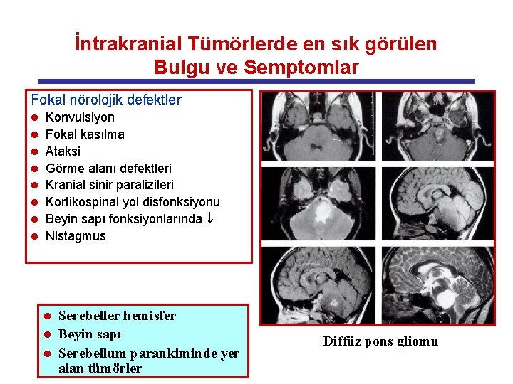 İntrakranial Tümörlerde en sık görülen Bulgu ve Semptomlar Fokal nörolojik defektler l l l