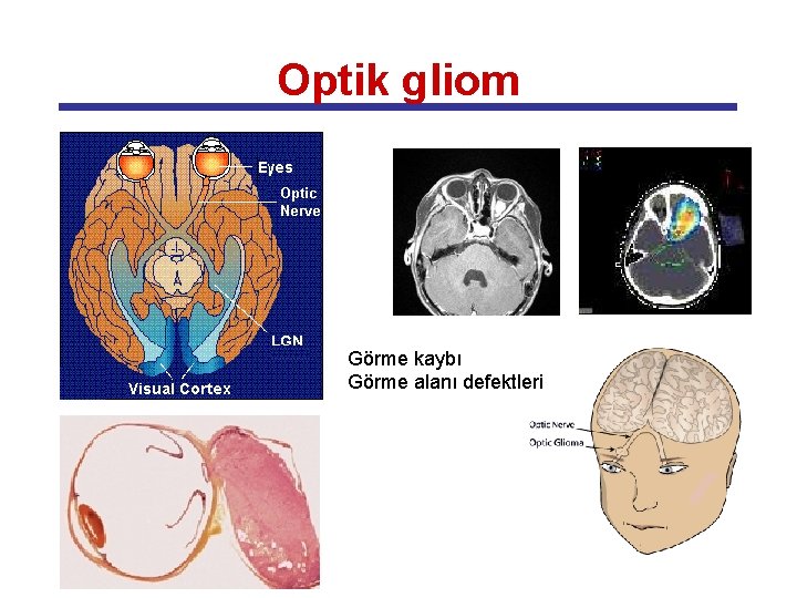 Optik gliom Görme kaybı Görme alanı defektleri 