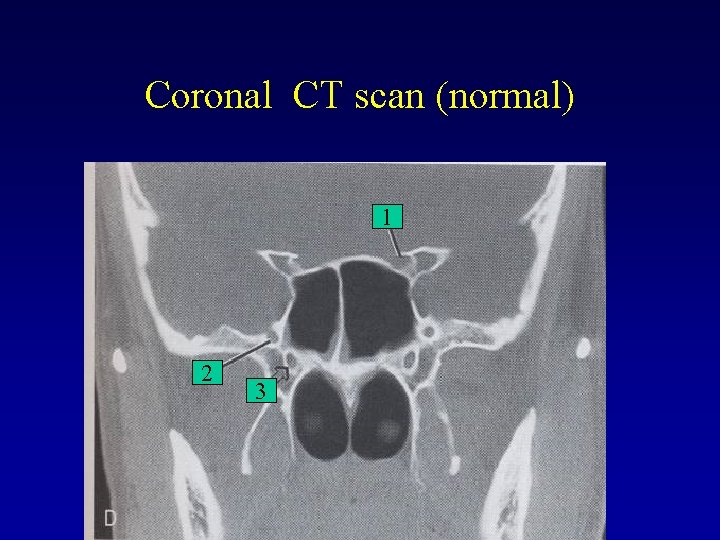 Coronal CT scan (normal) 1 2 3 Coronal CT scan (normal) 1 2 3