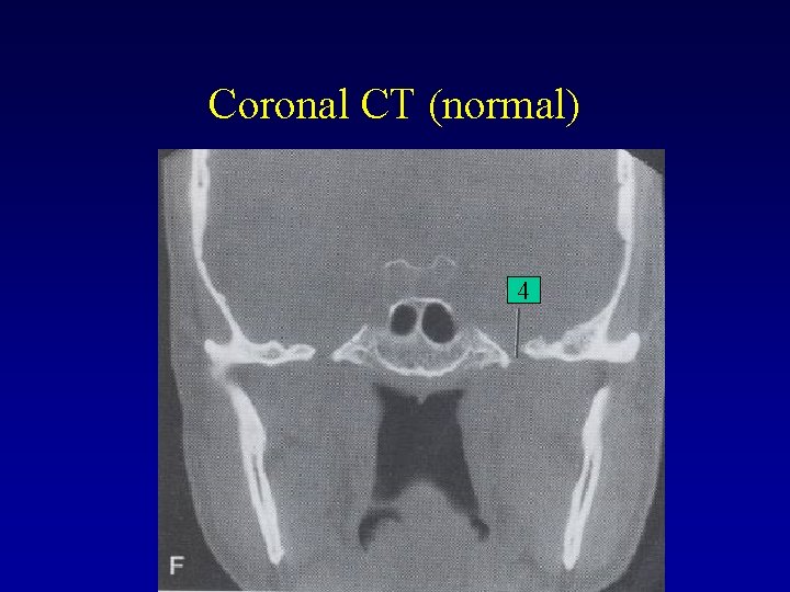 Coronal CT (normal) 4 Coronal CT (normal) 4