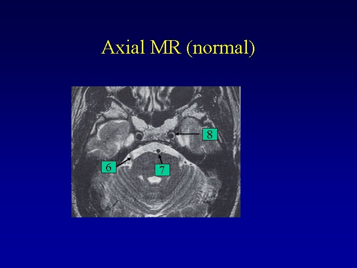 Axial MR (normal) 8 6 7 Axial MR (normal) 8 6 7