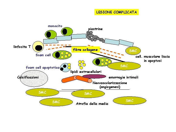 LESIONE COMPLICATA monocito linfocita T piastrine fibre collagene SMC foam cell. muscolare liscia in