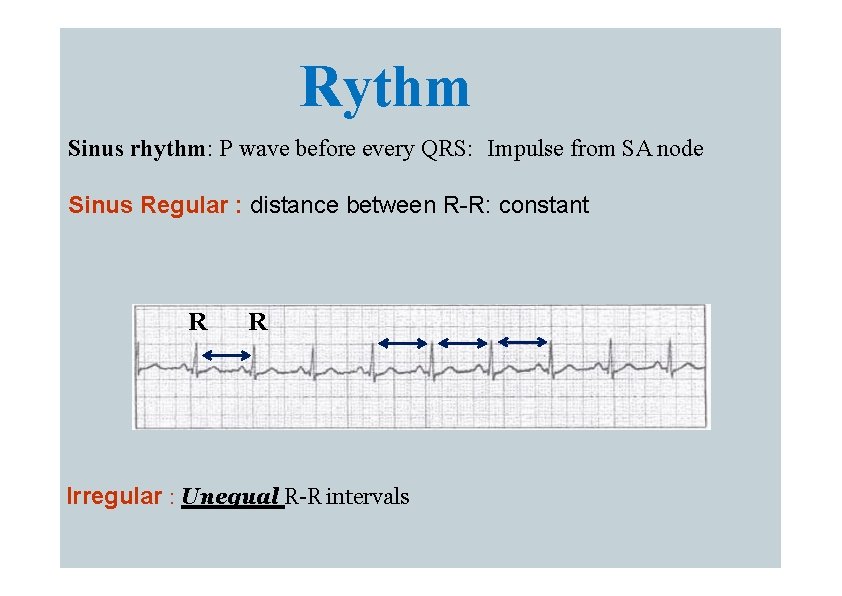 Rythm Sinus rhythm: P wave before every QRS: Impulse from SA node Sinus Regular