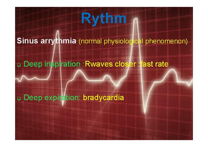 Rythm Sinus arrythmia (normal physiological phenomenon) Deep inspiration : Rwaves closer : fast rate