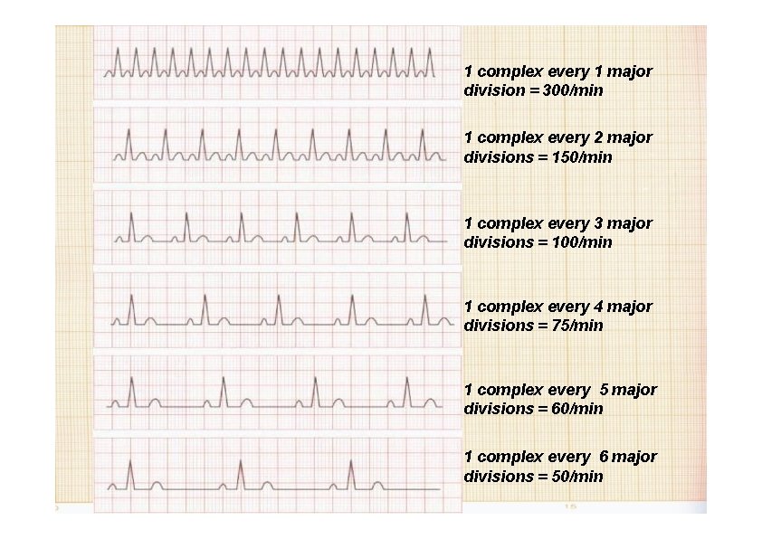 1 complex every 1 major division = 300/min 1 complex every 2 major divisions