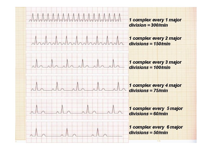 1 complex every 1 major division = 300/min 1 complex every 2 major divisions