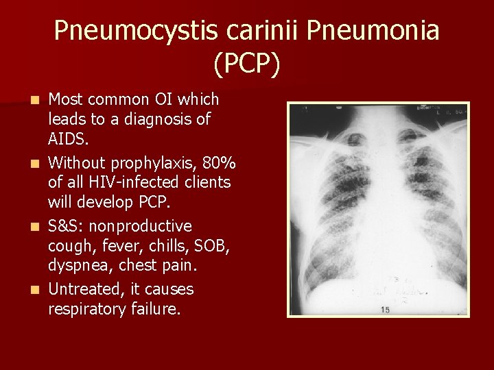 Pneumocystis carinii Pneumonia (PCP) Most common OI which leads to a diagnosis of AIDS.