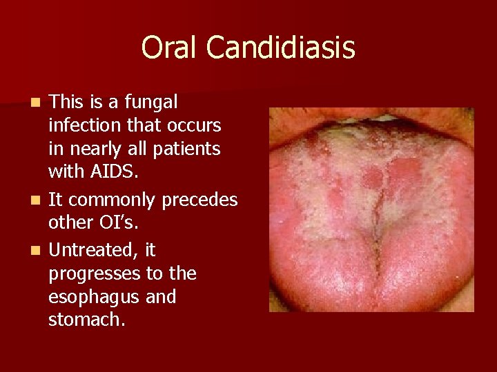 Oral Candidiasis This is a fungal infection that occurs in nearly all patients with