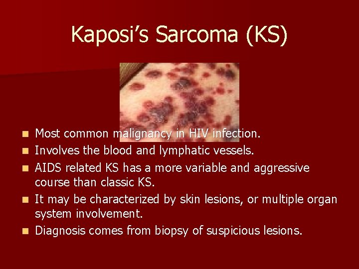 Kaposi’s Sarcoma (KS) n n n Most common malignancy in HIV infection. Involves the
