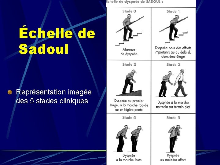 Échelle de Sadoul Représentation imagée des 5 stades cliniques 