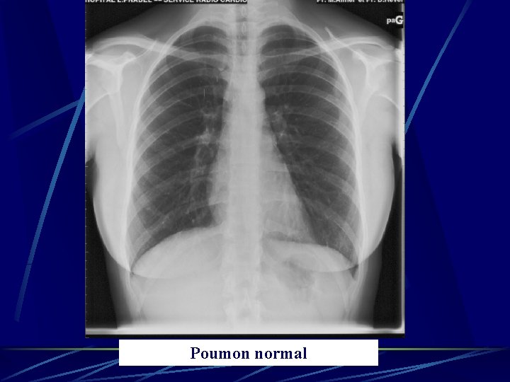 Poumon normal 