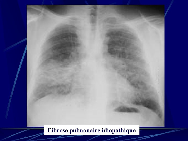 Fibrose pulmonaire idiopathique 