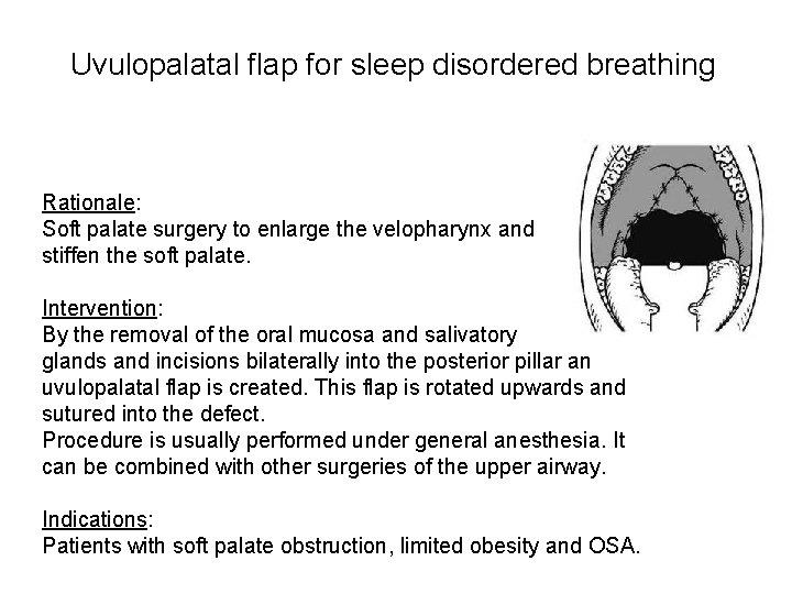 Uvulopalatal flap for sleep disordered breathing Rationale: Soft palate surgery to enlarge the velopharynx Uvulopalatal flap for sleep disordered breathing Rationale: Soft palate surgery to enlarge the velopharynx