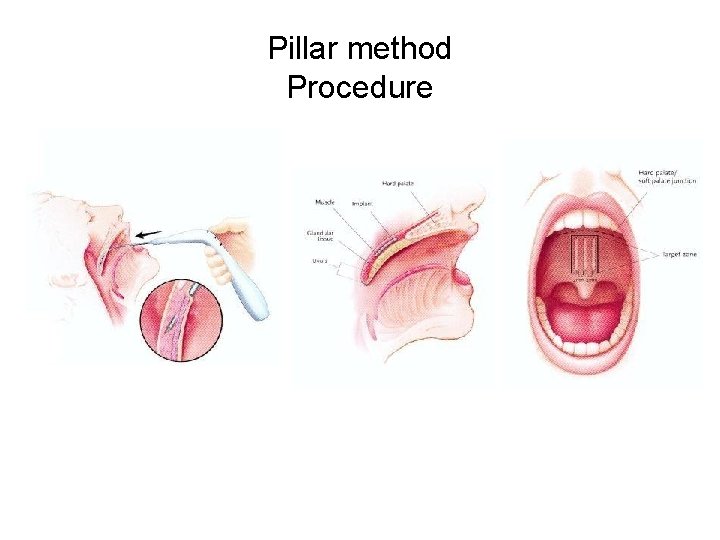 Pillar method Procedure Pillar method Procedure