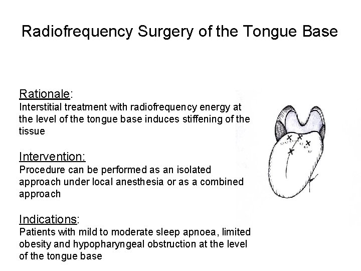 Radiofrequency Surgery of the Tongue Base Rationale: Indikationen: Interstitial treatment with radiofrequency energy at Radiofrequency Surgery of the Tongue Base Rationale: Indikationen: Interstitial treatment with radiofrequency energy at