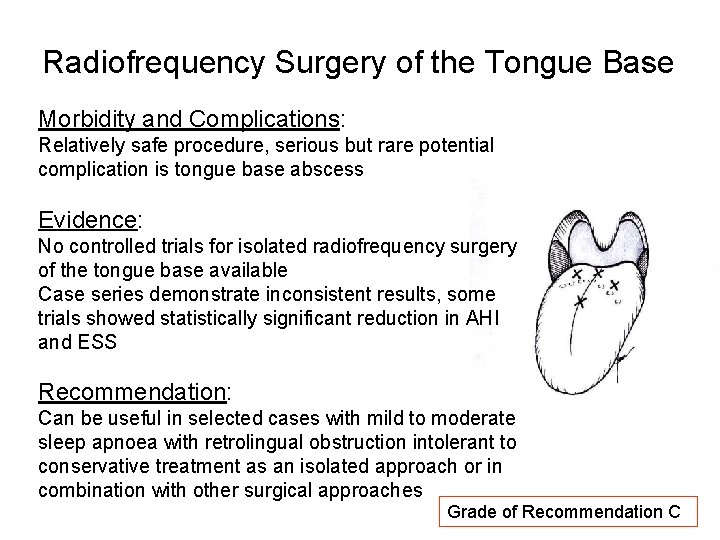 Radiofrequency Surgery of the Tongue Base Morbidity and Complications: Relatively safe procedure, serious but Radiofrequency Surgery of the Tongue Base Morbidity and Complications: Relatively safe procedure, serious but