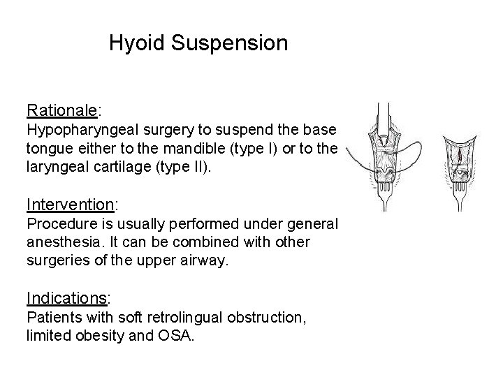 Hyoid Suspension Rationale: Hypopharyngeal surgery to suspend the base of tongue either to the Hyoid Suspension Rationale: Hypopharyngeal surgery to suspend the base of tongue either to the