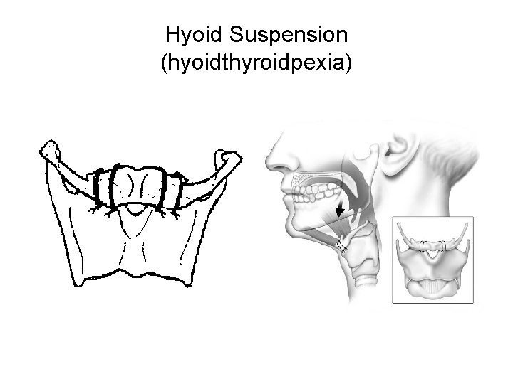 Hyoid Suspension (hyoidthyroidpexia) Hyoid Suspension (hyoidthyroidpexia)
