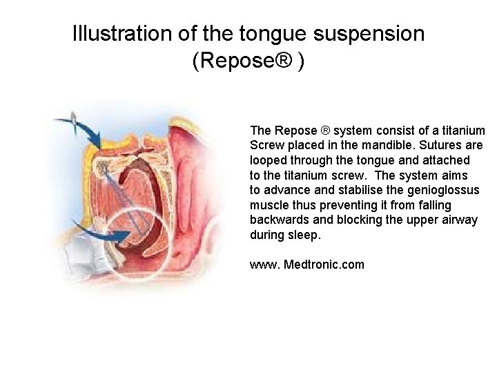Illustration of the tongue suspension (Repose® ) The Repose ® system consist of a Illustration of the tongue suspension (Repose® ) The Repose ® system consist of a